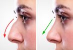 nose surgery
